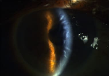 Slit lamp photograph of a 62-year-old man with Fuc