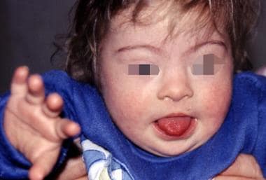 Dermatologic Manifestations of Down Syndrome: Overview, Clinical  Evaluation, Diagnostic Studies