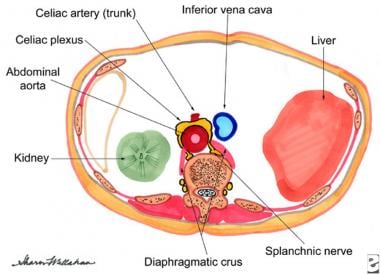 Pertinent anatomy for celiac plexus block (cross-s