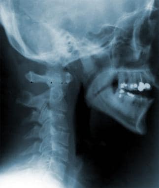 This radiograph shows the normal relationships bet