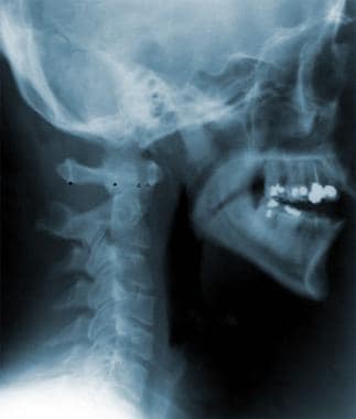 atlanto occipital joint xray