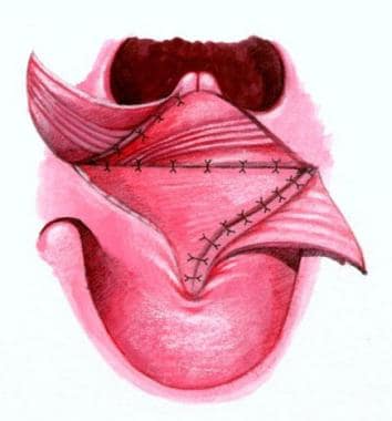 Illustration of Furlow technique, third step. 