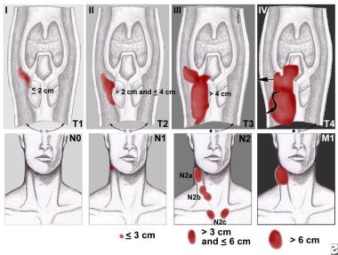 pyriform sinus cancer