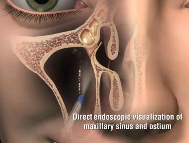 Entry into the maxillary sinus with the Entellus d