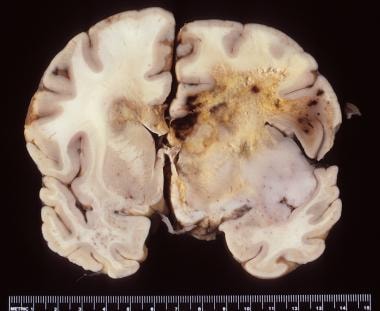 Gross photograph of a glioblastoma with diffuse he