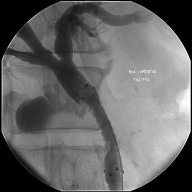 Self-expanding stent placed in the common bile duc