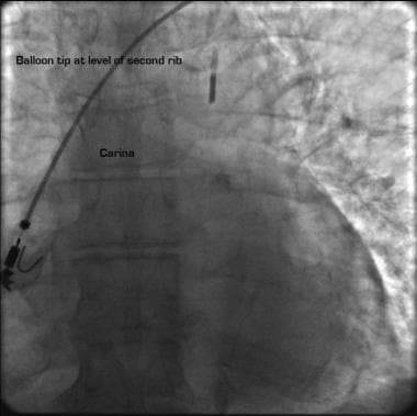 Chest radiograph demonstrating proper positioning 
