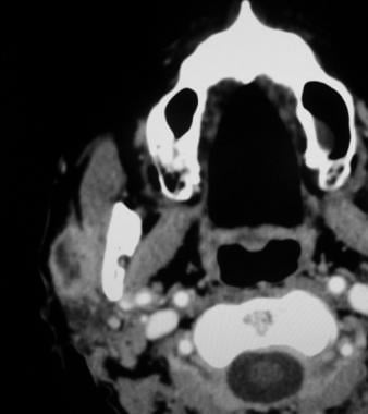 Axial contrast-enhanced CT scan demonstrating mass