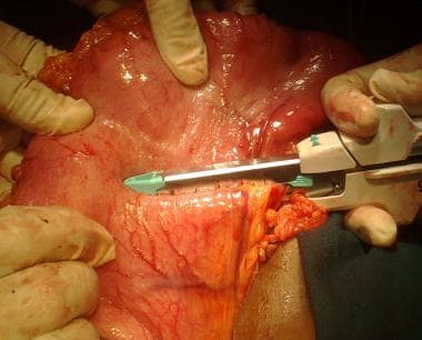 Subtotal gastrectomy in progress. Linear cutter be