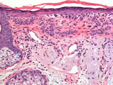 The basal keratinocytes show dysplastic changes, i