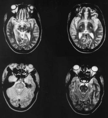 Axial T2-weighted magnetic resonance images of the