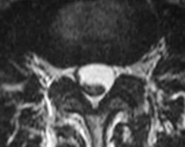 Axial T2-weighted MRI of the lumbar spine in arach