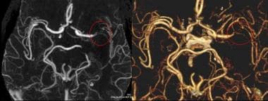 MIP and surface volume rendered images of the circ