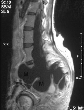 Sagittal T2-weighted MRI in a 28-year-old woman sh