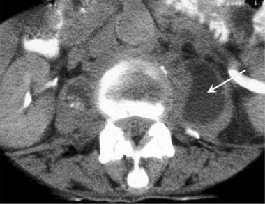 Axial computed tomography image from a patient who