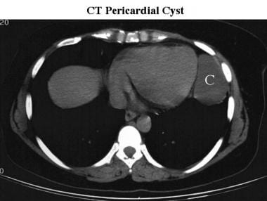 CT scan of a pericardial cyst. A well-defined apic