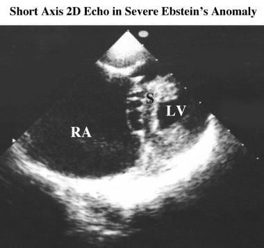 Short-axis image from a 2-dimensional echocardiogr