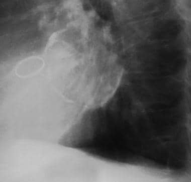 Lateral chest radiograph of a patient with left at
