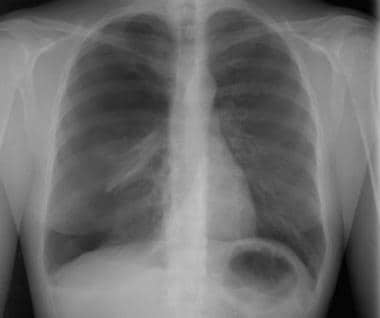 tension pneumothorax mediastinal shift