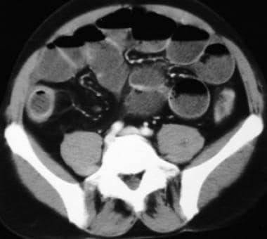 Crohn disease. Small-bowel obstruction in a patien