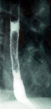 Reflux esophagitis is demonstrated on barium esoph