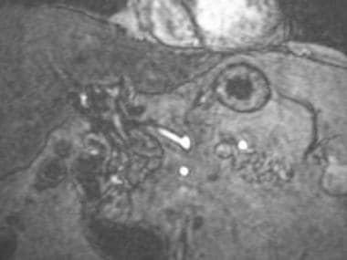 A-1: Magnetic resonance angiogram in a transplanta