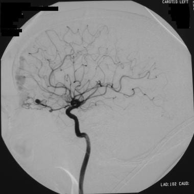Left internal carotid angiogram in a patient with 