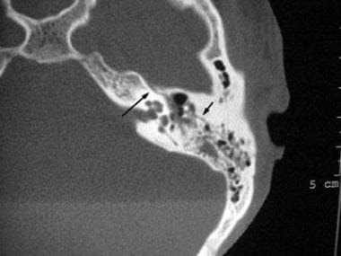 Temporal Bone Fracture Types