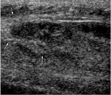Longitudinal ultrasonogram of the medial thigh in 
