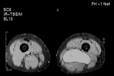 Fat-saturated magnetic resonance imaging (MRI) sca