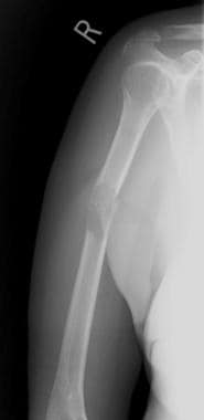 Radiograph of the right humerus. This image demons
