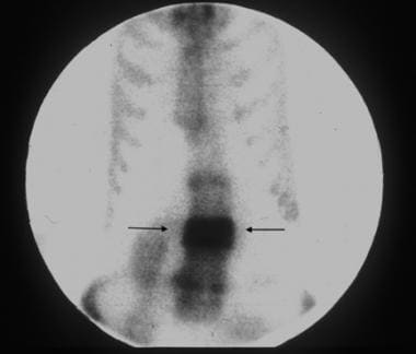 Anterior image of the thoracic and lumbar spine in
