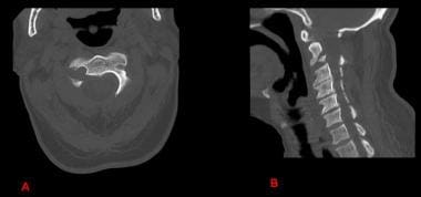 Computed tomographic axial cut (A) and sagittal re