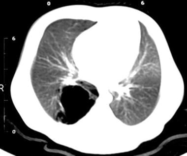 CT scan of the chest demonstrating a multiseptated