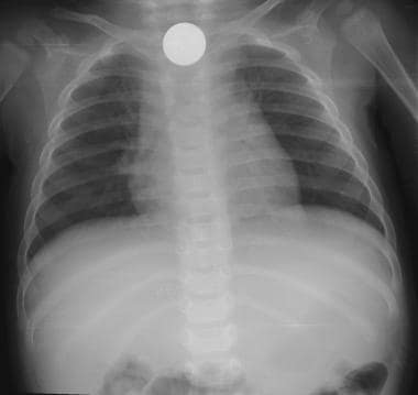 Anteroposterior chest radiograph depicts a penny a