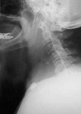 Soft-tissue neck radiograph demonstrates retrophar