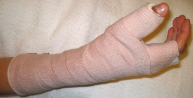 Short thumb spica cast. (a) The stockinette is pulled back to allow