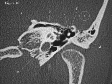CT scan, temporal bone. Coronal section through th