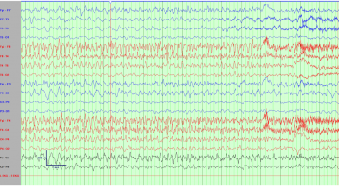 Electroencephalogram demonstrating a right frontal