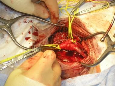 External carotid artery is dissected free of surro