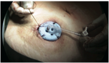 Placement of the single port trocar at the ostomy 