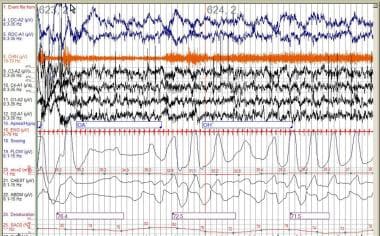 Example of an obstructive apnea and an obstructive