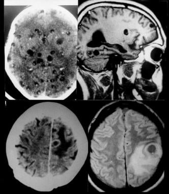 Neuroimaging in neurocysticercosis. CT scans showi