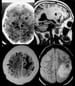 Neuroimaging in Neurocysticercosis