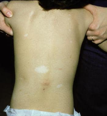 Which Cutaneous Findings Are Characteristic Of Tuberous Sclerosis