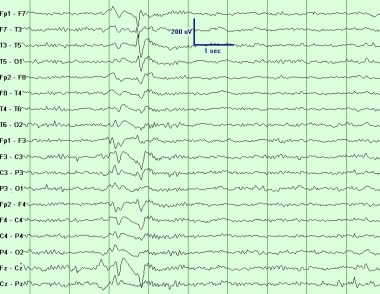 partial seizure