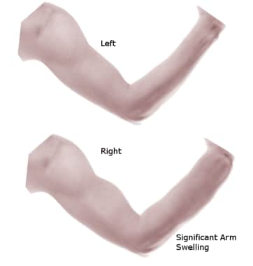 thrombophlebitis arm