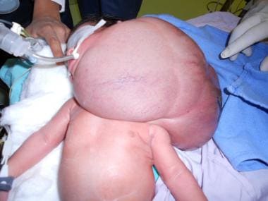 Clinical image of 2-day-old male with massive mixe