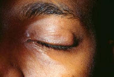 Chalazion. Image courtesy of Larry Stack, MD 