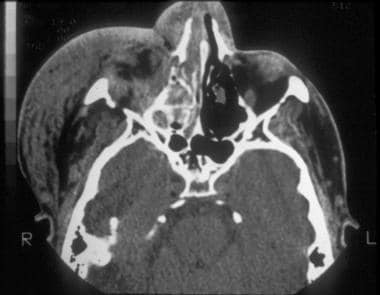 zygomatic arch radiograph